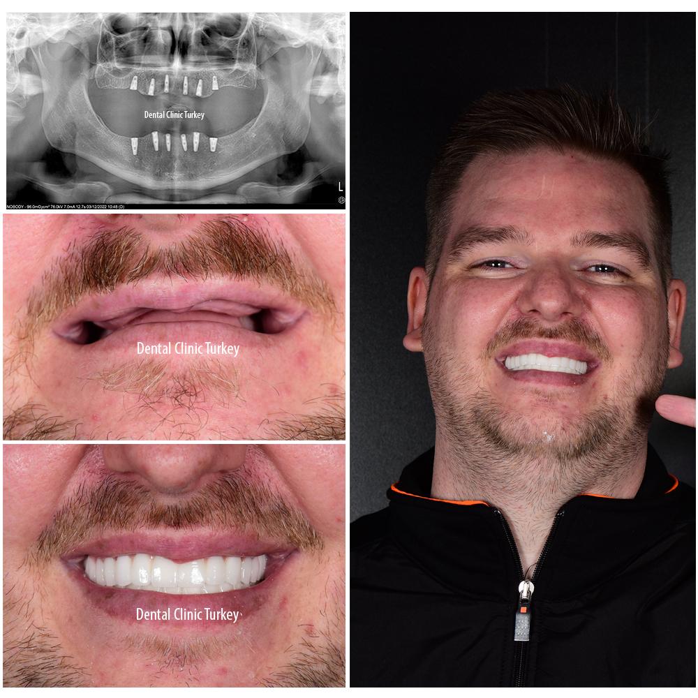 Innovative Techniques Behind the All-on-Six Procedure