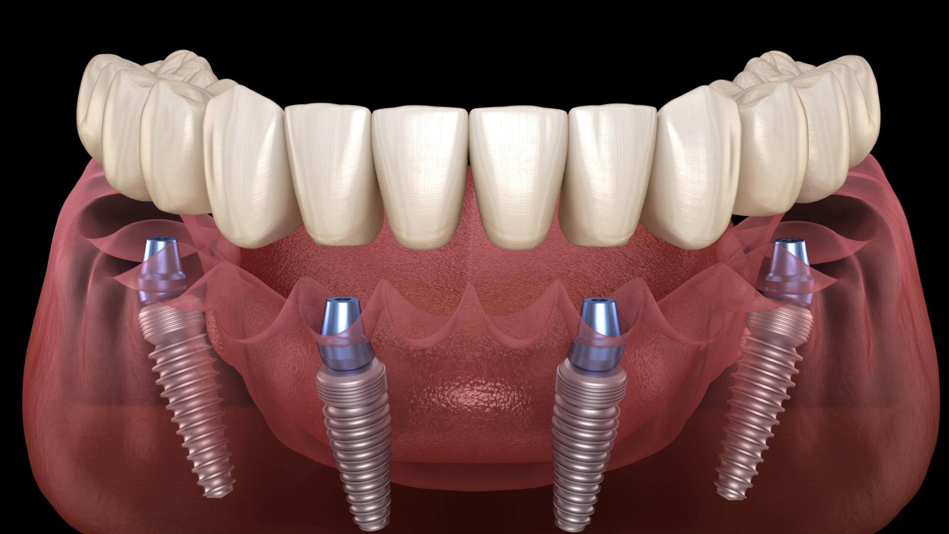 Post-Procedure Care Tips Ensuring Longevity and Confidence in Your New Smile