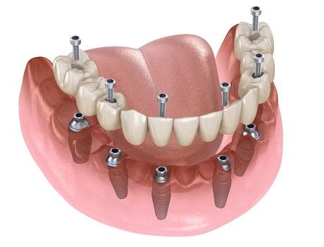 Understanding the Long-Term Health Advantages of All-on-Six Implants