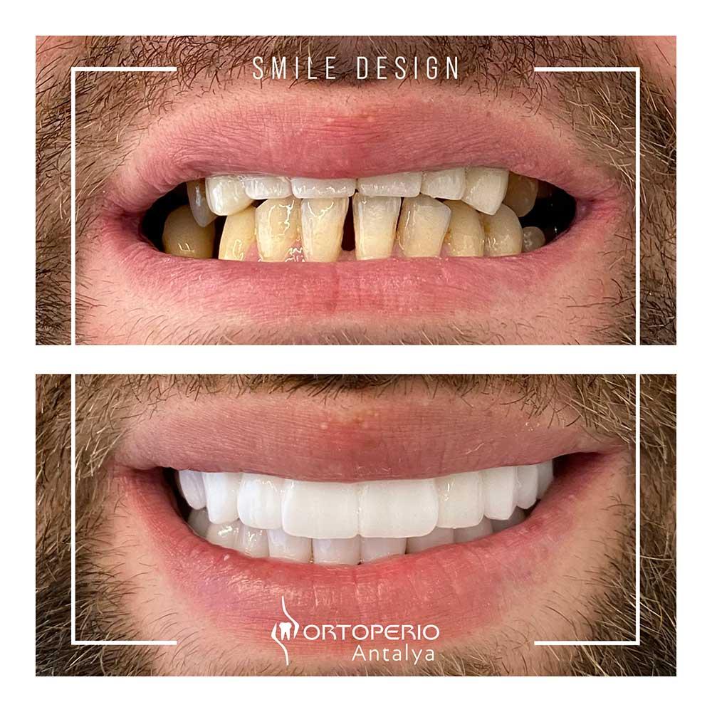 Exploring OrtoperioAntalya's Expertise in All-on-Four Implant Solutions