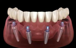 Compare Your Options: All-on-Six Implants in Antalya vs. Alternatives in the UK