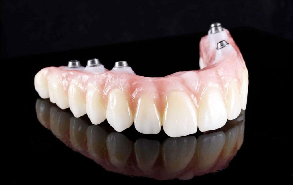 From Missing Teeth to a Full Smile: Understanding the All-on-Six Implant Journey in Antalya