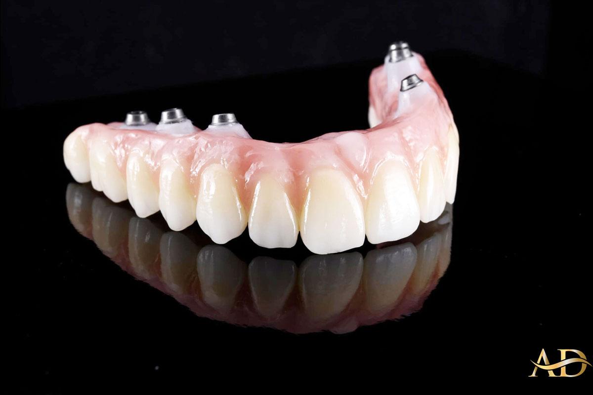Key Factors in Choosing Antalya for Your All-on-Six Implant Procedure