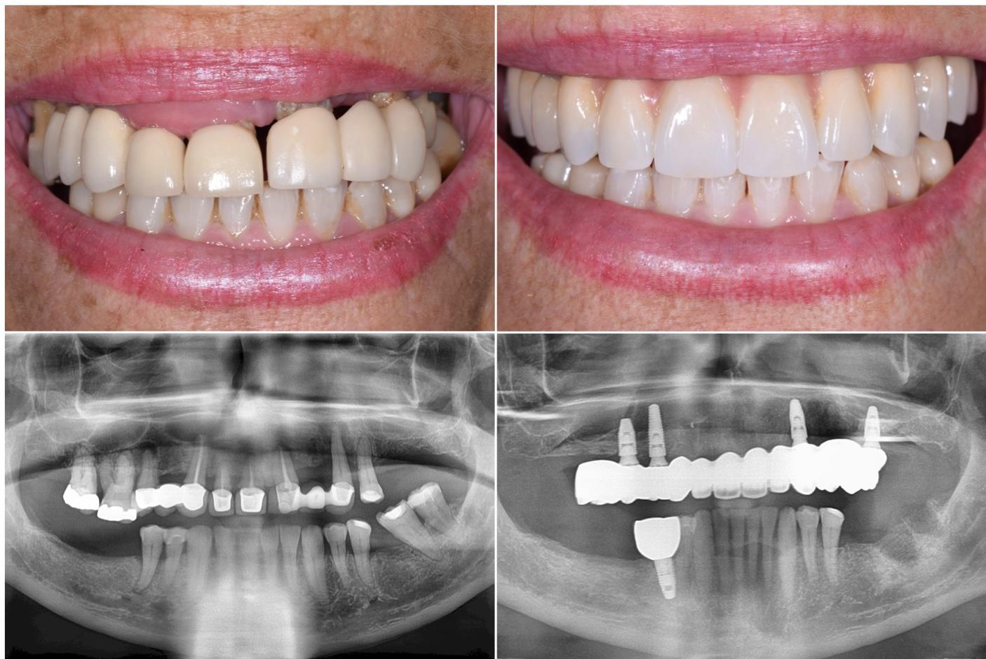 Comparing All-on-Four Implant Prices in the UK and Antalya Understanding the Factors Driving Cost Differences Evaluating Quality and Safety Standards Beyond the Price Tag Practical Tips for Choosing the Best Implant Option for Your Budget and Health