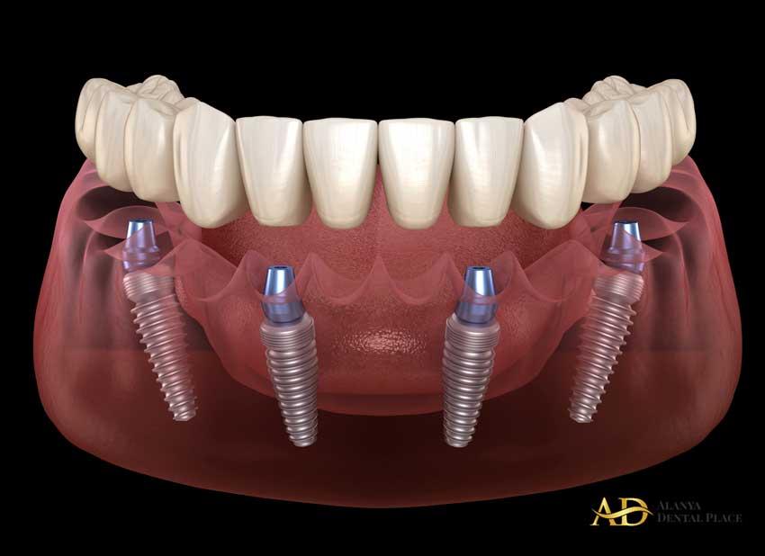 Post-Treatment Care and Maintenance Maximizing Longevity and Natural Appearance