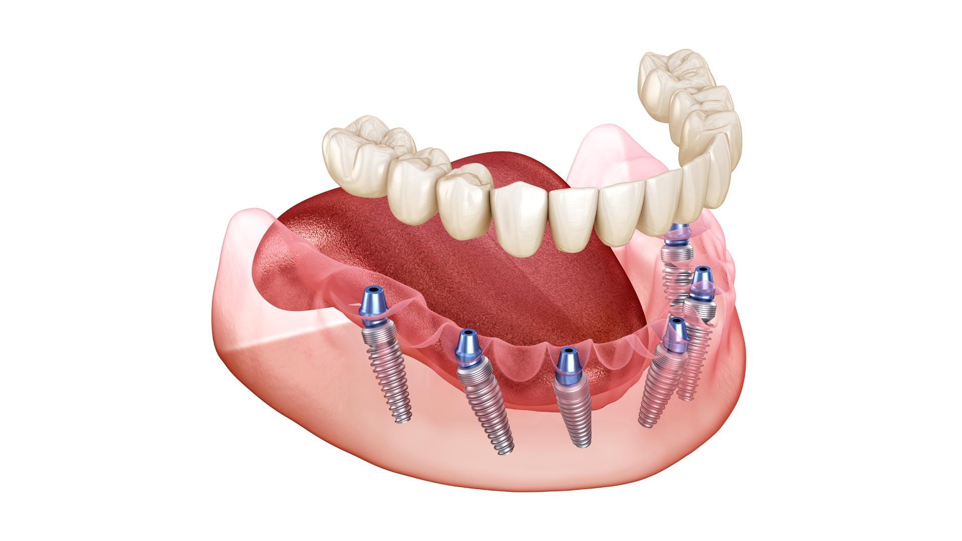 Choosing the Right Clinic in Antalya for Personalized and Transparent Dental Care