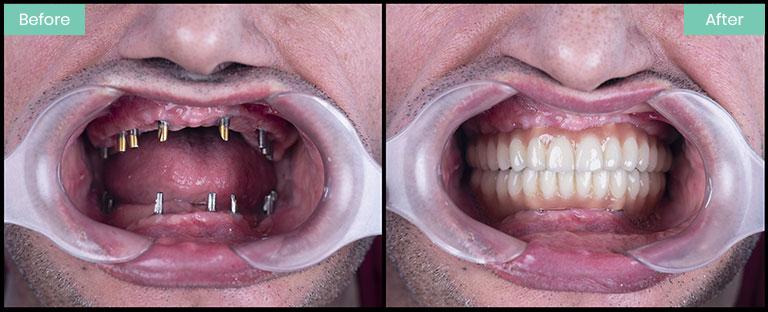 Tips for UK Patients Planning Dental Implants Abroad Preparing for Your Trip and Ensuring a Smooth Experience