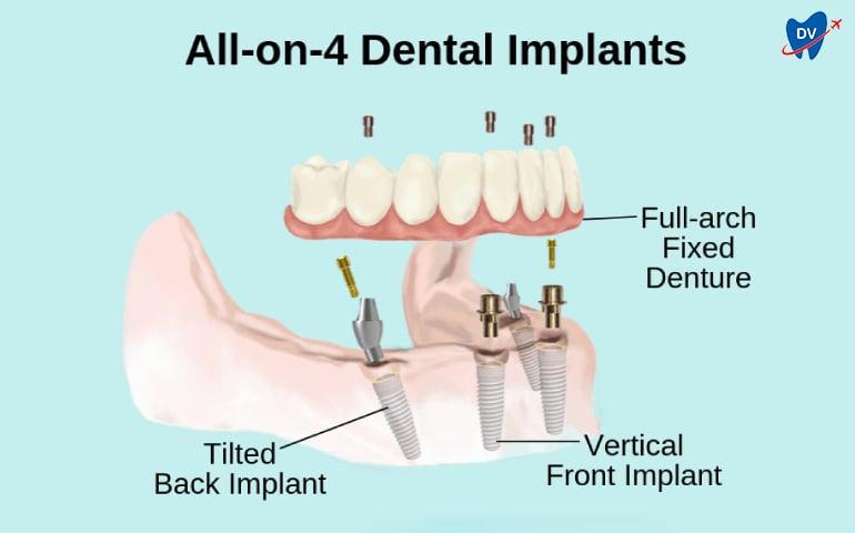 Understanding the Benefits of All on 4 and All on 6 Dental Implant Techniques