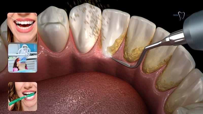 Daily Hygiene Practices to Protect Your Implants and Gums