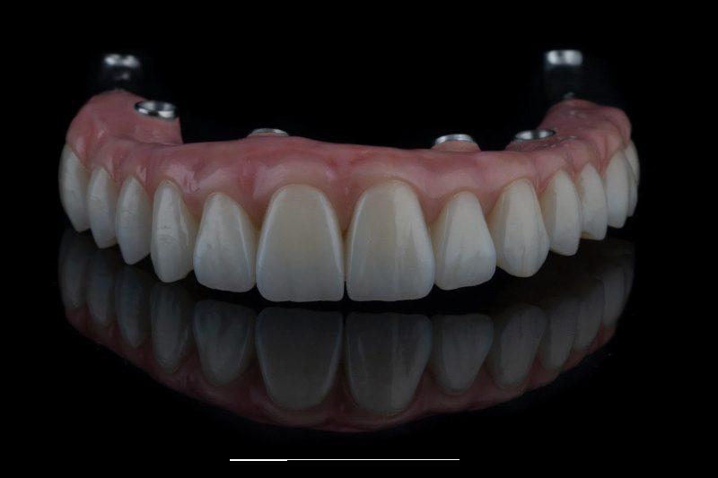 Understanding the Advanced Techniques Behind Superior Implant Quality