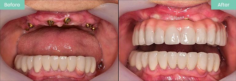 The Real Cost of All-on-Four Implants: UK Prices vs. Incredible Value in Antalya
