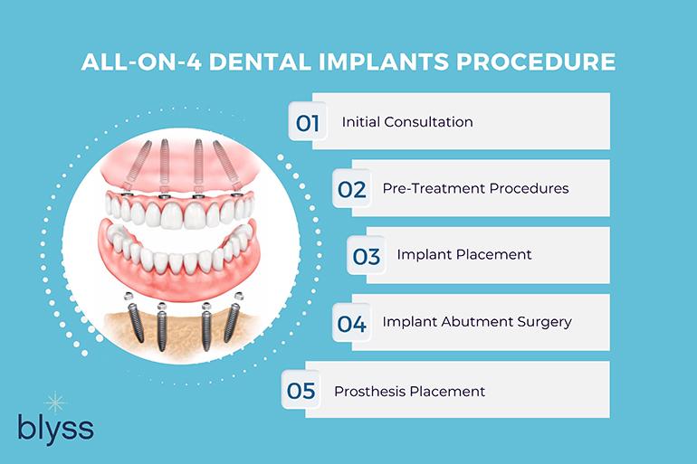 The All-on-Four Implant Procedure Explained