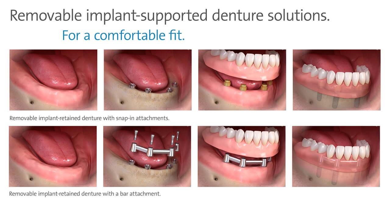 The Foundation of Stability Understanding the All-on-4 Implant Technique