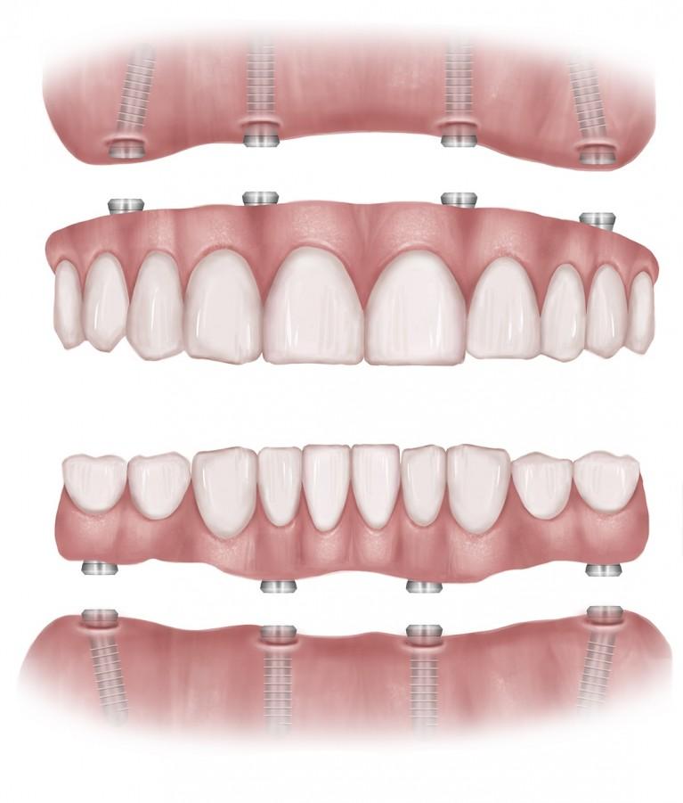 Understanding the All-on-Six Procedure and Its Benefits for UK Patients