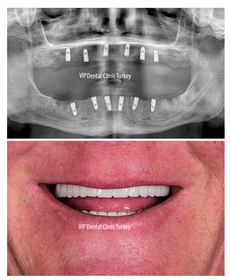 Why Antalya is a Trusted Destination for Dental Treatment Abroad