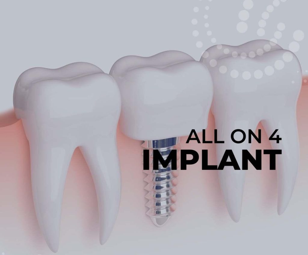 "All on Four Implant Antalya": What Makes This a Top Search for UK Smile Seekers?