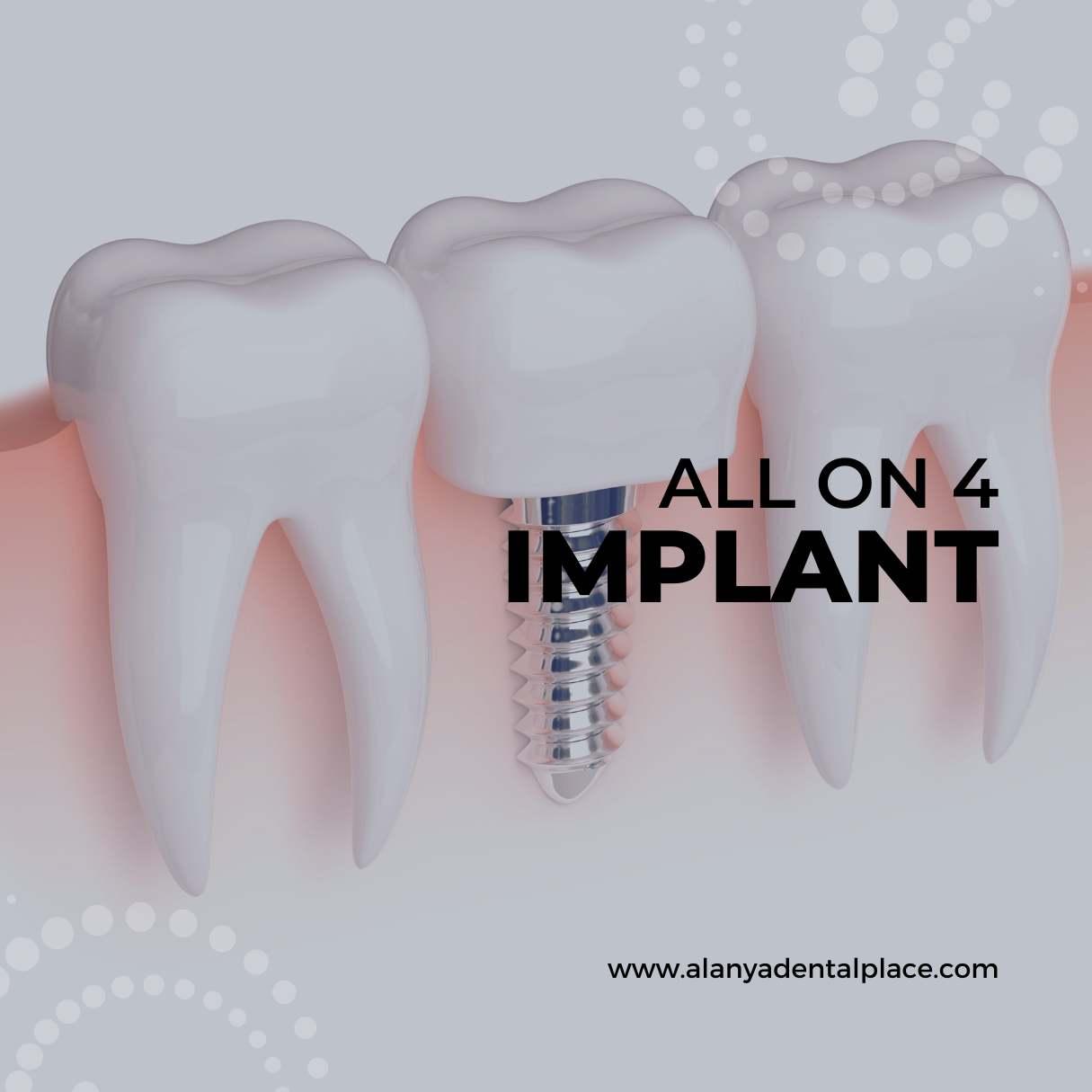 Navigating the Journey From Consultation to Completion Tips for Ensuring a Smooth and Successful Implant Experience